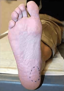 Can You Run With Plantar Fasciitis?