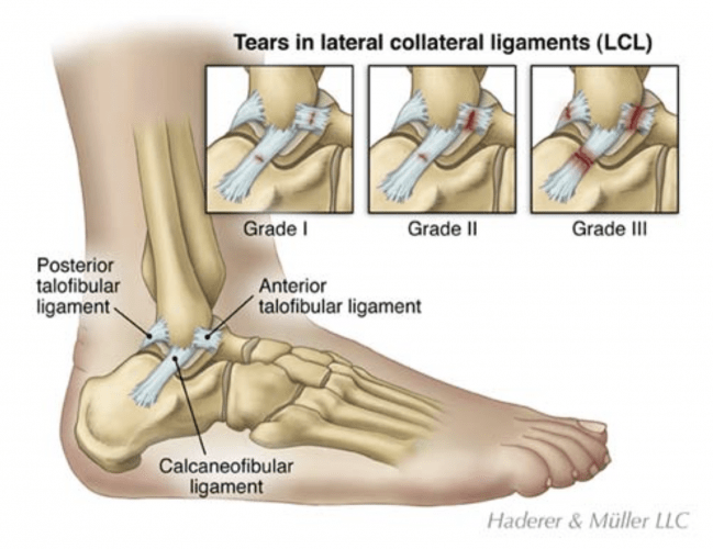 Lateral ankle ligament anatomy showing ATFL, CFL and PTFL
